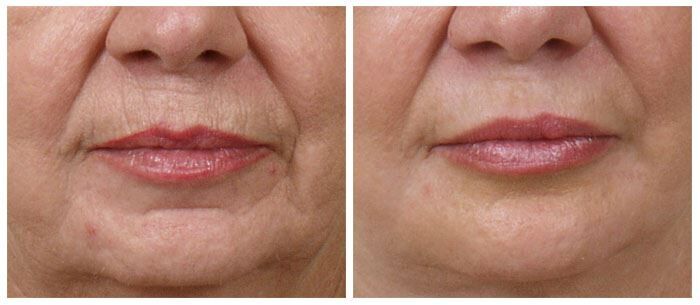 Get Laser Skin Resurfacing for Youthful Skin