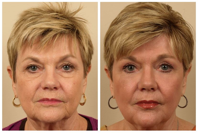 Laser Skin Resurfacing for Smooth, Radiant Skin