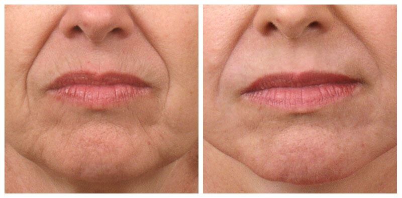 Laser Skin Resurfacing to Reduce Wrinkles and Scars